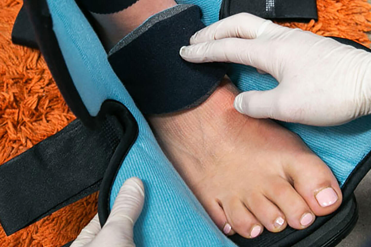 Ankle Fracture  Orthotics Plus Melbourne