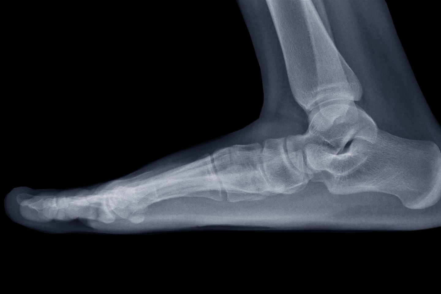 Lateral Right Foot X-ray Showing Destruction of the Posteroinferior Aspect  of the Calcaneus Stock Image - Image of finger, defect: 206252641