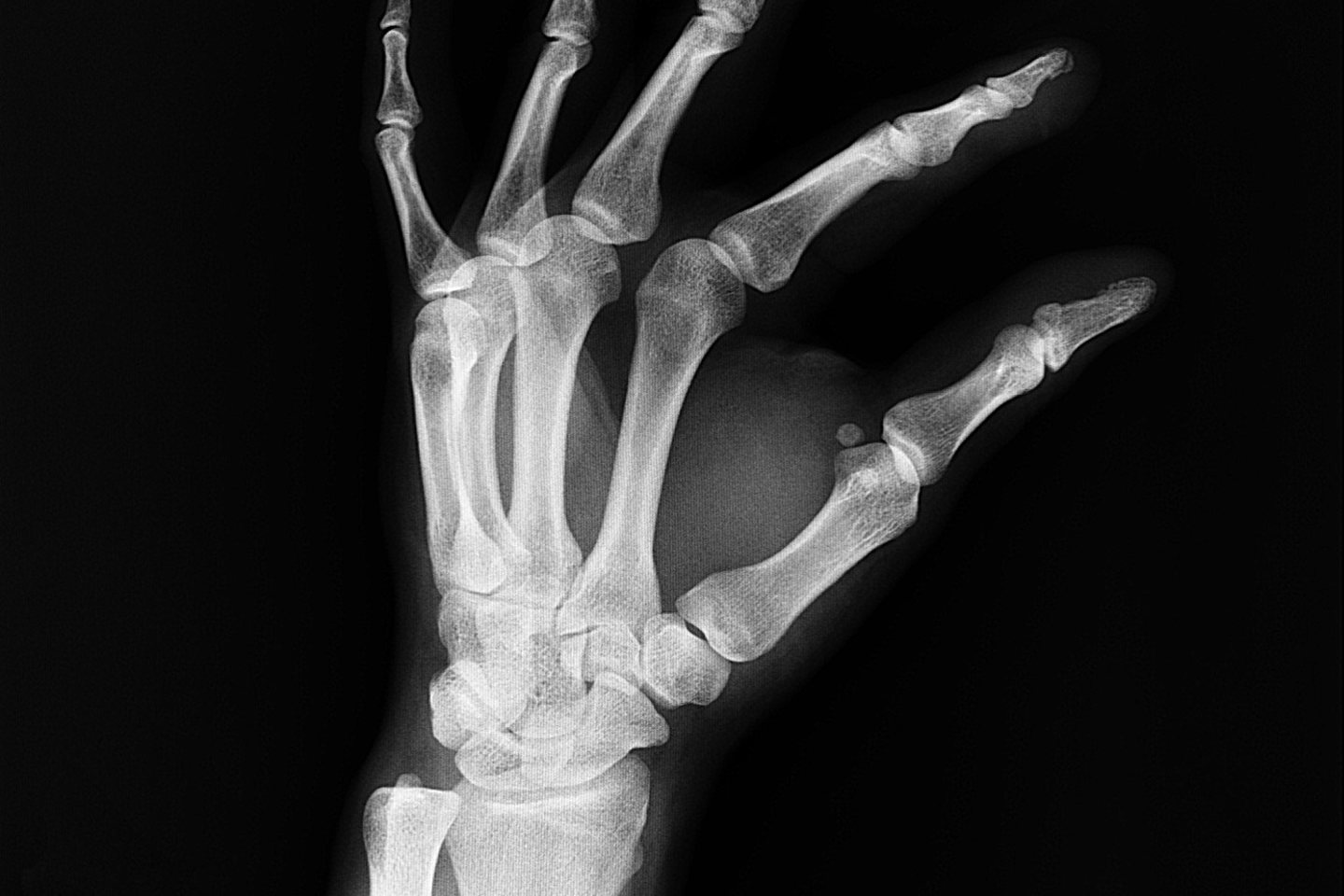 scaphoid fracture cast