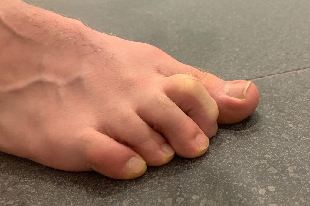 Claw Toes | Orthotics Plus Melbourne