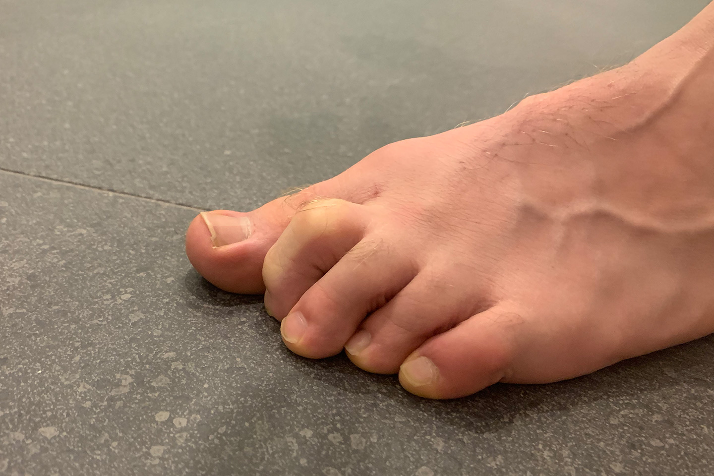 Claw Toes | Orthotics Plus Melbourne