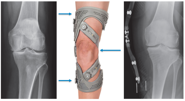 Unloader Knee Brace, Osteoarthritis Support