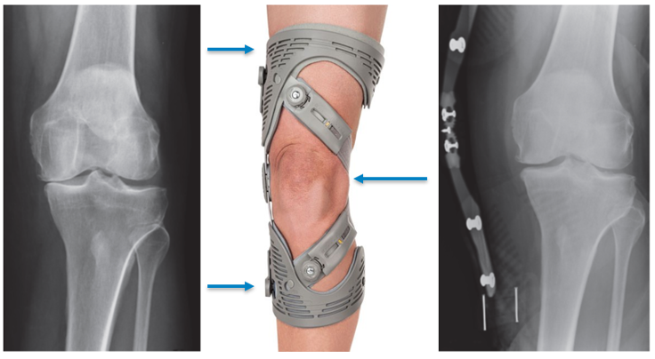 OA Unloader Knee Brace - Arthritis Pain Relief, Osteoarthritis, Bone on  Bone Knee Joint Pain, Medial or Lateral Unloader Knee Brace, Knee Pain  Relief