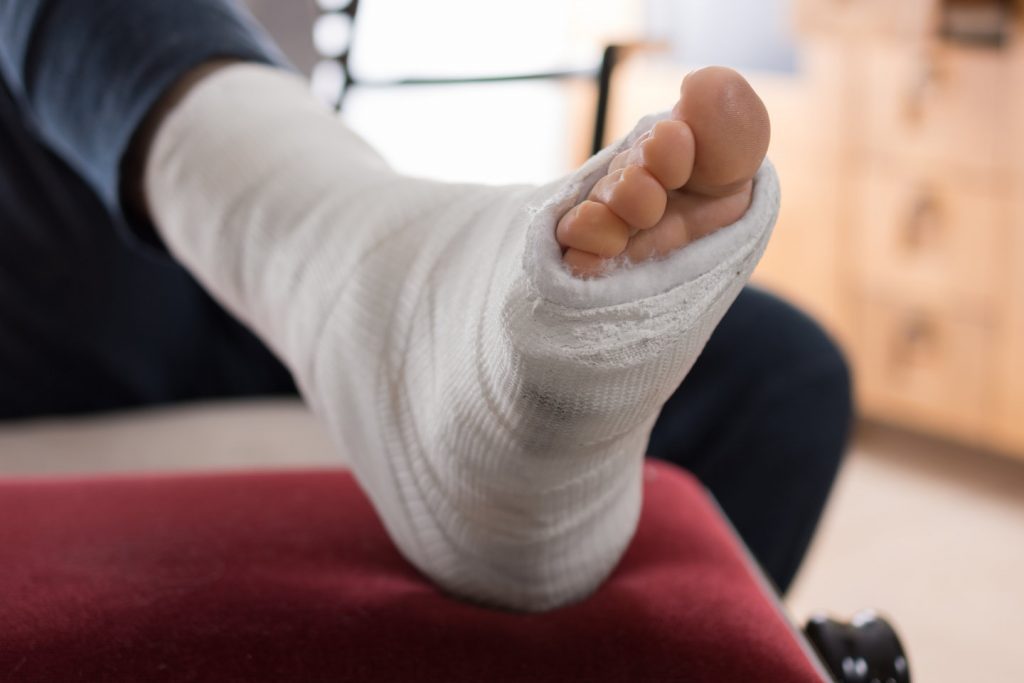 Close up of a young man's fiberglass / Plaster leg cast and toes after a running injury