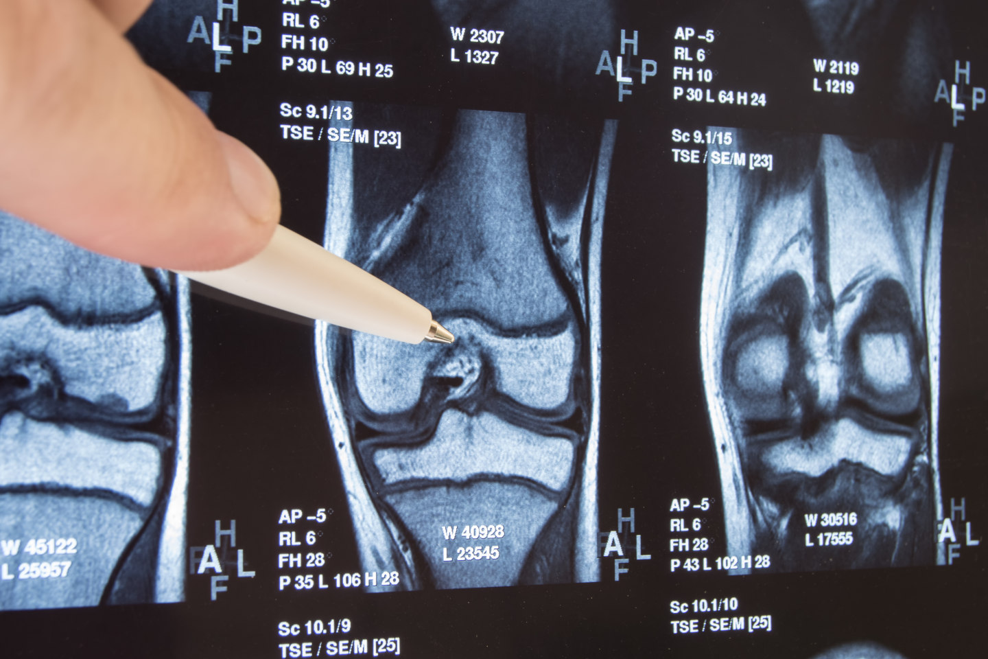 Leg Length Discrepancy After Hip Replacement