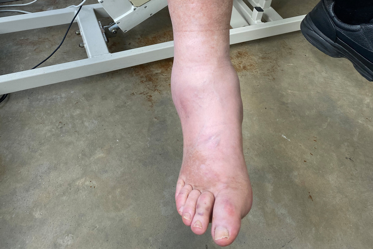 An Orthotics Plus patient with Charcot foot.