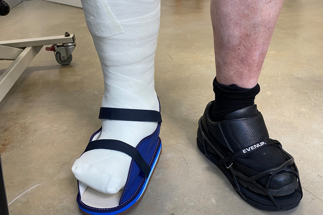 An Orthotics Plus patient wearing a Total Contact Cast and over cast shoe.