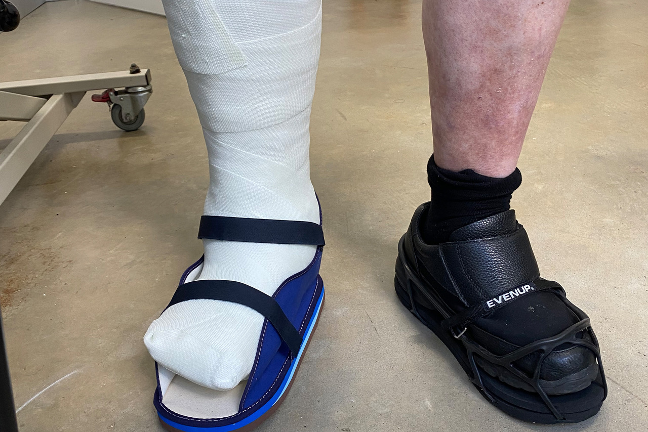 Total Contact Cast | Orthotics Plus Melbourne