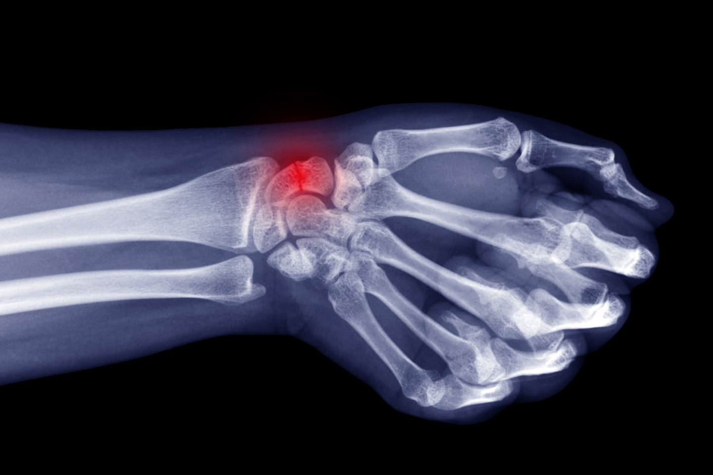 acute buckle fracture wrist