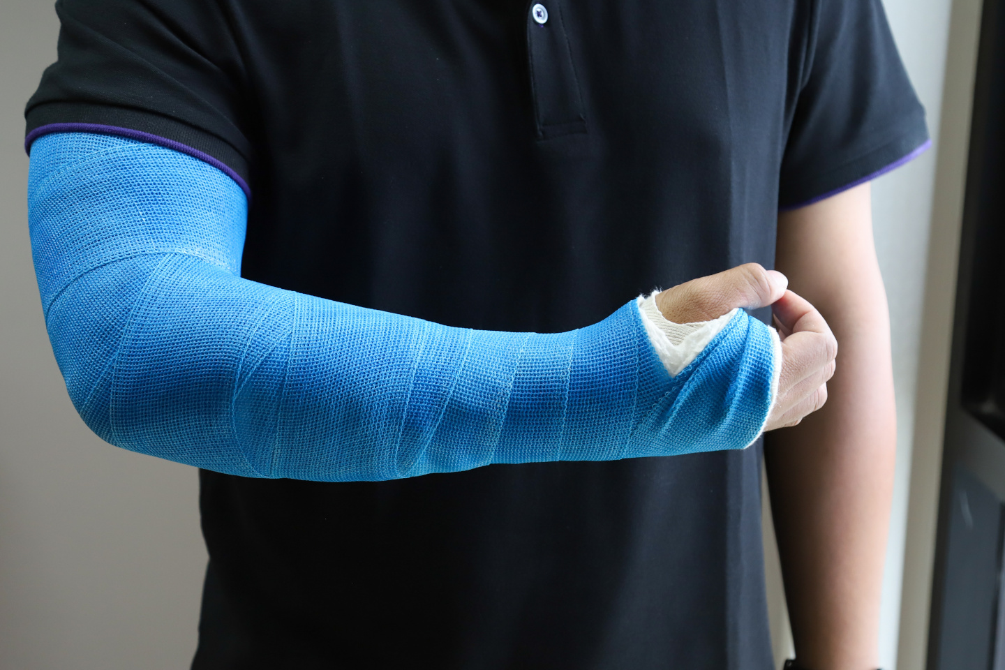 Closeup of asian man's arm with long arm plaster, fiberglass cast therapy cover by blue elastic bandage after sport accident. Appropriate treatment in western medicine.