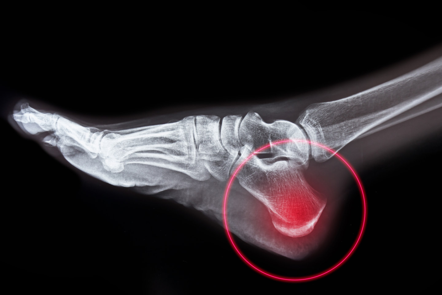 Buckle Fracture: Symptoms, Causes & Treatment