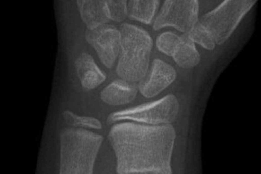 Buckle Fracture Casting | Orthotics Plus Melbourne