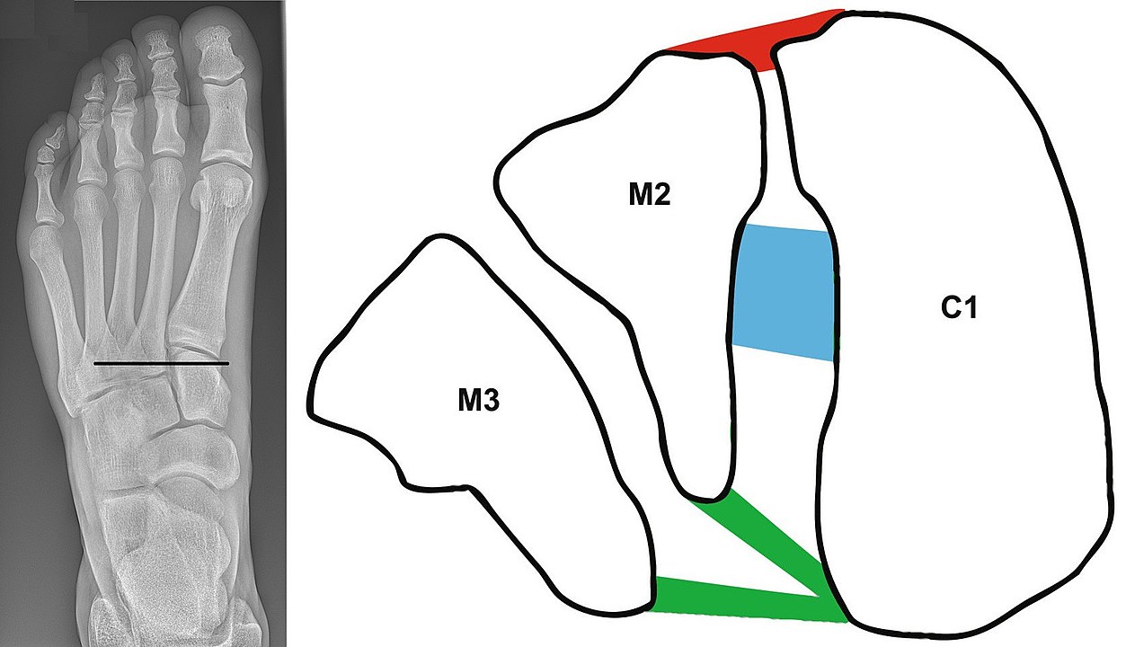 By Left image: Mikael Häggström.Right image: Article authors: David D Rettedal, Nathan C Graves, Joshua J Marshall, Katherine Frush and Vassilios Vardaxis - Combination of:Left image: File:X-ray of normal right foot by dorsoplantar projection.jpg (Public Domain)Right image: "Figure 1" from: (2013). "Reliability of ultrasound imaging in the assessment of the dorsal Lisfranc ligament". Journal of Foot and Ankle Research 6 (1). DOI:10.1186/1757-1146-6-7. ISSN 1757-1146. ((CC BY 2.0)), CC BY 2.0, https://commons.wikimedia.org/w/index.php?curid=65064857
